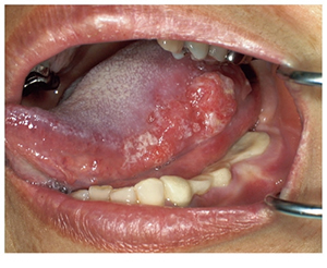 舌がん（口腔がん）写真